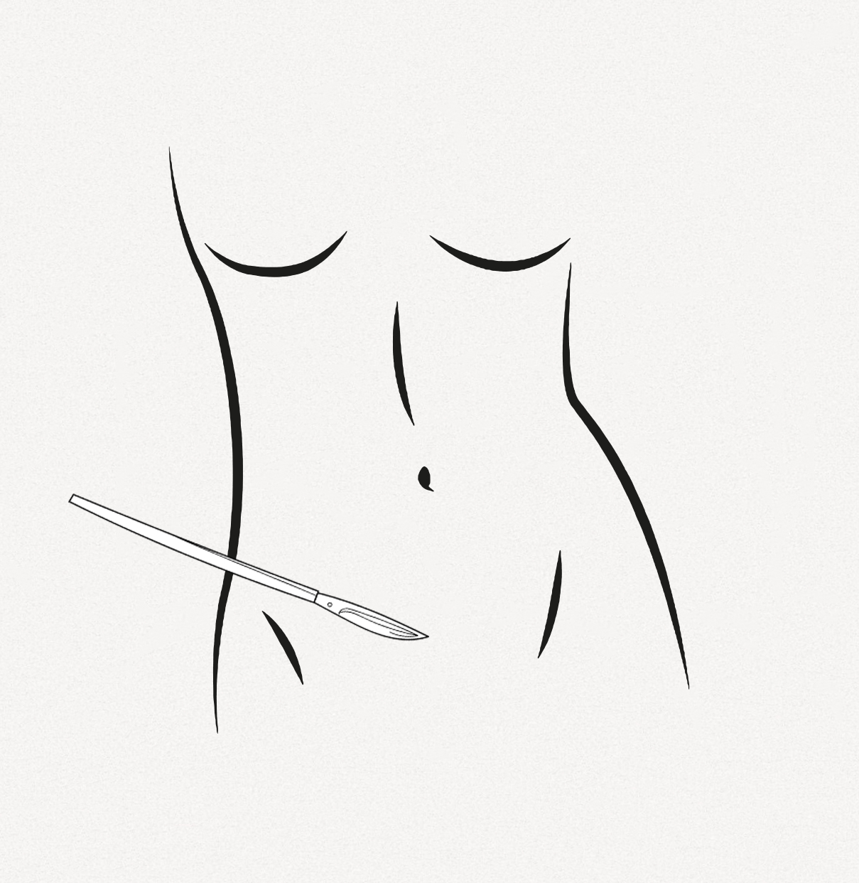 Bauchdeckenstraffung Bauchdeckenstraffung