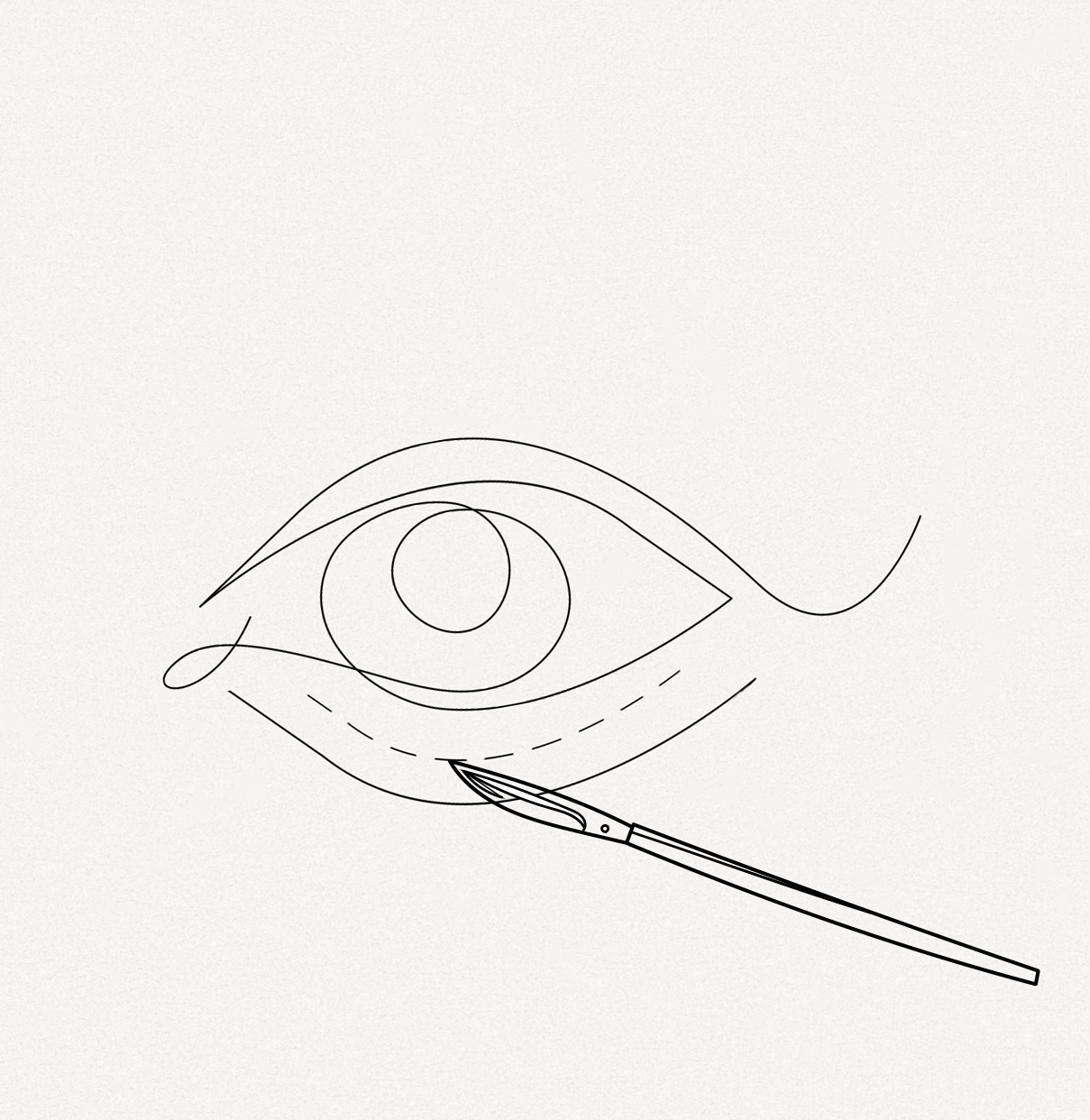 Unterlidstraffung Unterlidstraffung